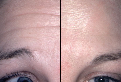 Trước và sau khi tiêm Botox: Thường phải mất 3 - 7 ngày sau tiêm, hiệu quả mới đạt tối đa. Tại khu vực tiêm, da sẽ mượt mà. Khi các cơ co trở lại, những nếp nhăn sẽ lại xuất hiện. Để duy trì hiệu quả, phải tiêm lặp lại mỗi 4 - 6 tháng.