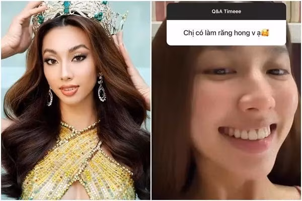 Các đường nét trên gương mặt của Thùy Tiên không còn mộc mạc như xưa mà đã có điểm nhấn thu hút hơn nhờ niềng răng.