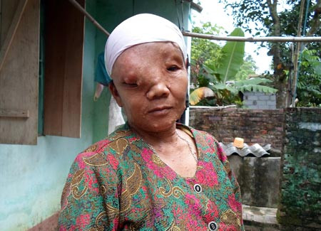 Chị Lê Thị Thành với khuôn mặt "quái dị" vì u bã đậu.