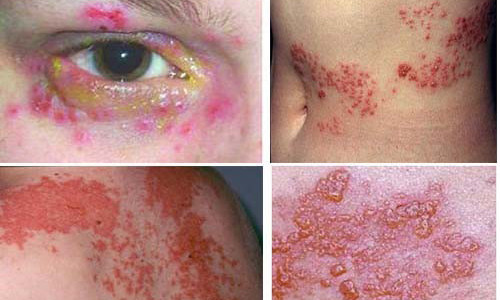 Bệnh nhân bị mò đốt.