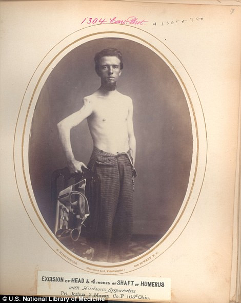 Binh nhì Joshua S. Mason bị thương tật ở tay phải, khiến cho cánh tay này bị biến dạng.