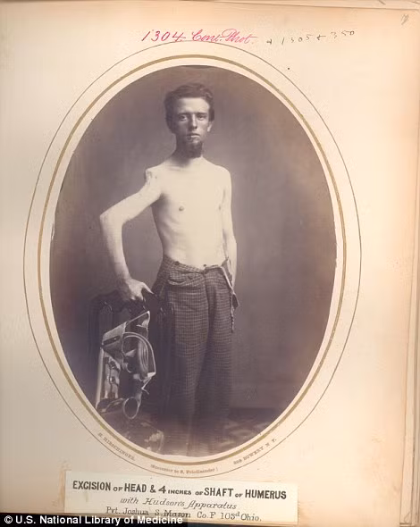 Binh nhì Joshua S. Mason bị thương tật ở tay phải, khiến cho cánh tay này bị biến dạng.