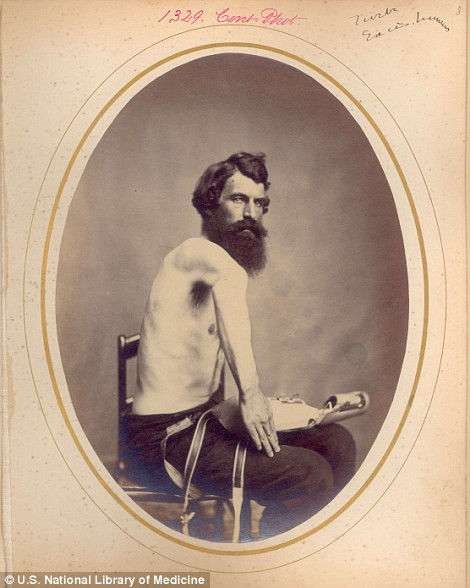 Cánh tay phải của binh nhì Francis Furber bị thương tật, tổn thương vĩnh viễn do tình hình chiến sự ác liệt. Rất nhiều binh sĩ thuộc quân đội Mỹ bị thương ở cánh tay phải.