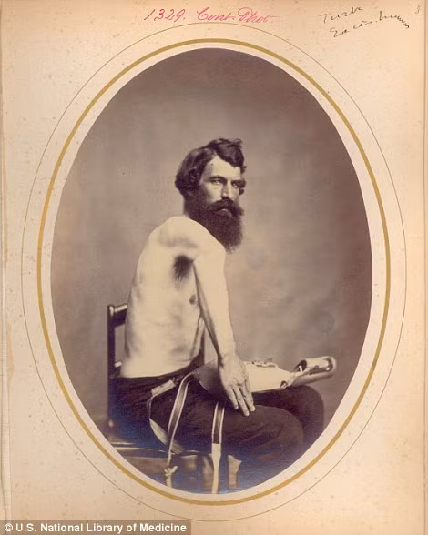 Cánh tay phải của binh nhì Francis Furber bị thương tật, tổn thương vĩnh viễn do tình hình chiến sự ác liệt. Rất nhiều binh sĩ thuộc quân đội Mỹ bị thương ở cánh tay phải.