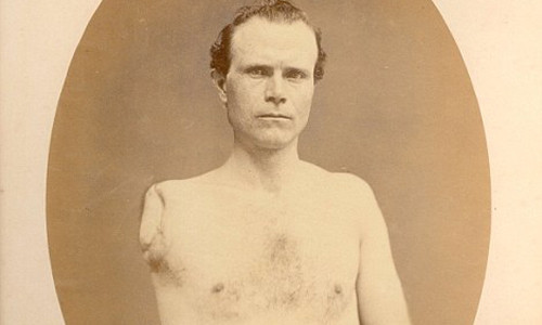 Samuel Irwin thuộc quân tình nguyện Pennsylvania số 67 phải cắt cụt cánh tay phải do bị thương lúc ra trận.