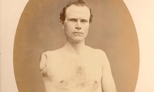 Samuel Irwin thuộc quân tình nguyện Pennsylvania số 67 phải cắt cụt cánh tay phải do bị thương lúc ra trận.