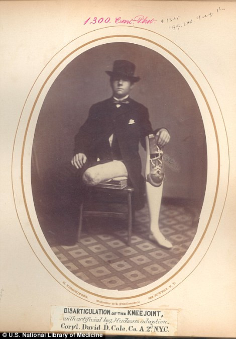 Tướng David D. Cole đã phải trải qua phẫu thuật cắt cụt chân, tháo khớp gối trong trận Amelia Courthouse.