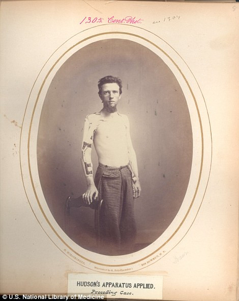 Một lính Mỹ bị thương tật ở cánh tay phải và phải sử dụng dụng cụ hỗ trợ cho tay để có thể cử động dễ dàng hơn.