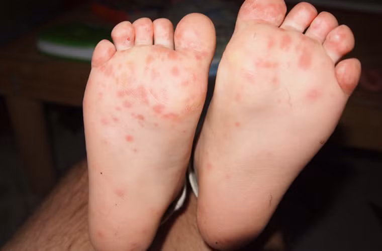 Hiện không có thuốc chủng ngừa nhằm chống lại các virus gây bệnh nhưng nỗ lực duy trì vệ sinh cá nhân sạch sẽ, khử trùng các vật dụng xung quanh bé sẽ giảm đáng kể nguy cơ mắc bệnh.