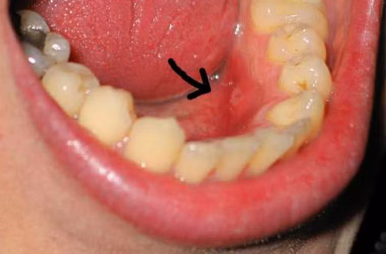 Những người này tự xác nhận họ không quan tâm lắm đến việc chăm sóc răng miệng. Kết quả là, các trường hợp thuộc diện lười vệ sinh răng miệng có nguy cơ nhiễm HPV qua đường miệng cao hơn 56%. Những người có vấn đề về nướu dễ đối diện với HPV cao hơn 51% và những người hỏng răng có xu hướng tăng 28% so với người bình thường.