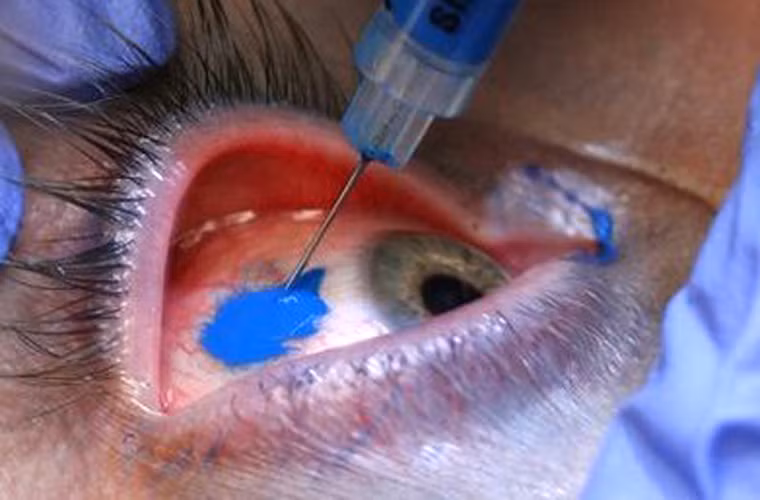 Xăm tròng mắt. Xăm tròng mắt có thể giúp thay đổi màu sắc của giác mạc đồng thời che được các nhược điểm như sẹo giác mạc hay ánh mắt buồn.