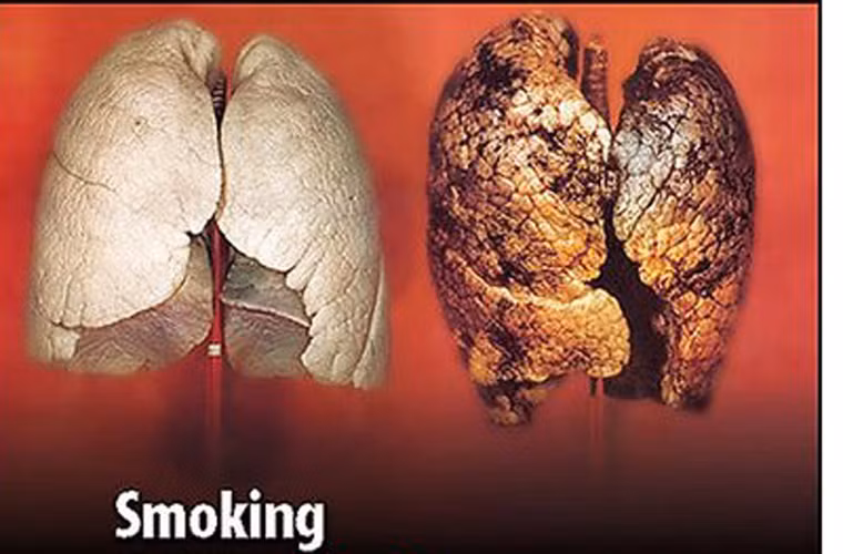 Hiện ung thư phổi, vú và đại tràng là ba dạng ung thư thường gặp nhất trên toàn thế giới. Trong khi đó, ung thư phổi, gan và dạ dày lại là ba dạng ung thư dễ cướp đi sinh mạng của bệnh nhân hơn cả.