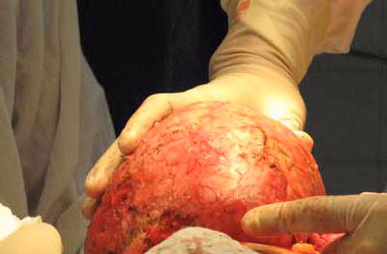 Kết quả trên được công bố tại Tạp chí Ung thư (Mỹ). Để đưa ra được nhận định trên, các nhà nghiên cứu đã theo dõi gần ba triệu trường hợp mắc u được chẩn đoán trong thời gian từ năm 2005 và 2009.