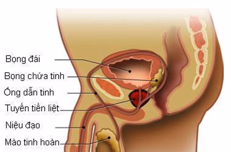 Viêm tiền liệt tuyến là một dạng viêm nhiễm ở tiền liệt tuyến. Ở giai đoạn đầu, người bệnh sẽ có các biểu hiện như đi tiểu nhiều lần, tiểu gấp, tiểu đau kèm theo sốt. số triệu chứng tiêu biểu như đi tiểu nhiều lần, tiểu gấp, tiểu đau, kèm theo sốt....