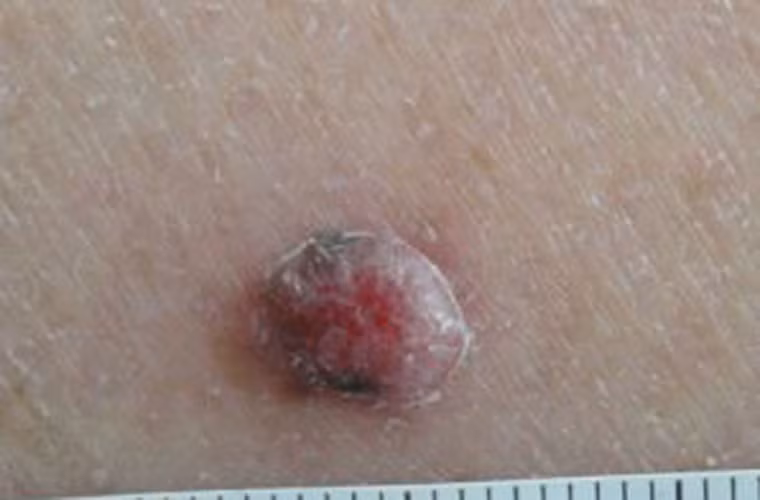 Loại khối u giống mụn thường xuất hiện ở trên đầu, mặt; hiếm khi được tìm thấy ở tay và chân. Nó có khả năng công phá vào lên các tế bào khỏe mạnh xung quanh nhanh hơn gấp 4 lần so với bình thường.