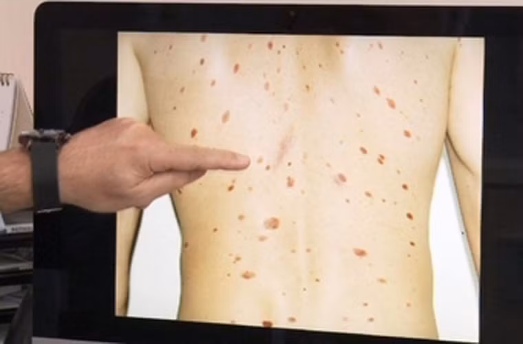 Một nghiên cứu khác từng được thực hiện bởi UCSF cũng chỉ ra phụ nữ khá giả dễ mắc ung thư da. Một điều bất ngờ nữa là 90% các dạng ung thư da nguy hiểm rơi vào nhóm người da trắng.