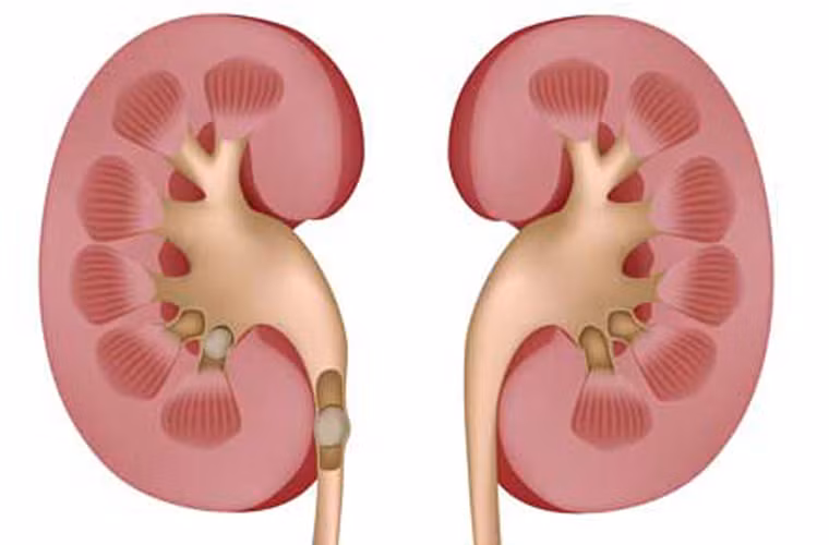 Sỏi thận. Nắng nóng khiến cơ thể dễ bị đổ mồ hôi, hạn chế lượng nước thải thông qua con đường tiểu tiện. Việc này dễ dẫn đến tình trạng hình thành sỏi trong thận và đường tiết niệu.