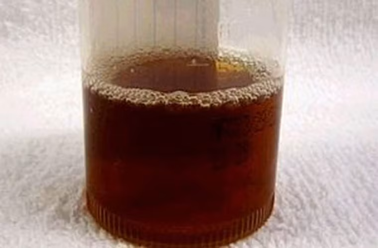 Nước tiểu thay đổi bất thường. Cùng với sự thay đổi của màu chất thải, người bệnh cũng dễ dàng nhận thấy sự bất thường thông qua mùi lạ từ nước tiểu. Nước tiểu của bệnh nhân thường có màu hồng nhạt. Khi dùng giấy vệ sinh, bạn dễ dàng nhận thấy các vệt máu trên màu giấy trắng.