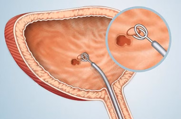 Ung thư bàng quang là sự hình thành các khối u bất thường trong bàng quang, màng lót, hạch bạch huyết... Người ta xác định thói quen hút thuốc lá là một trong những yếu tố chính gây bệnh. Trong trường hợp nặng, nếu không điều trị kịp thời bệnh nhân có thể đối diện với nguy cơ tử vong.