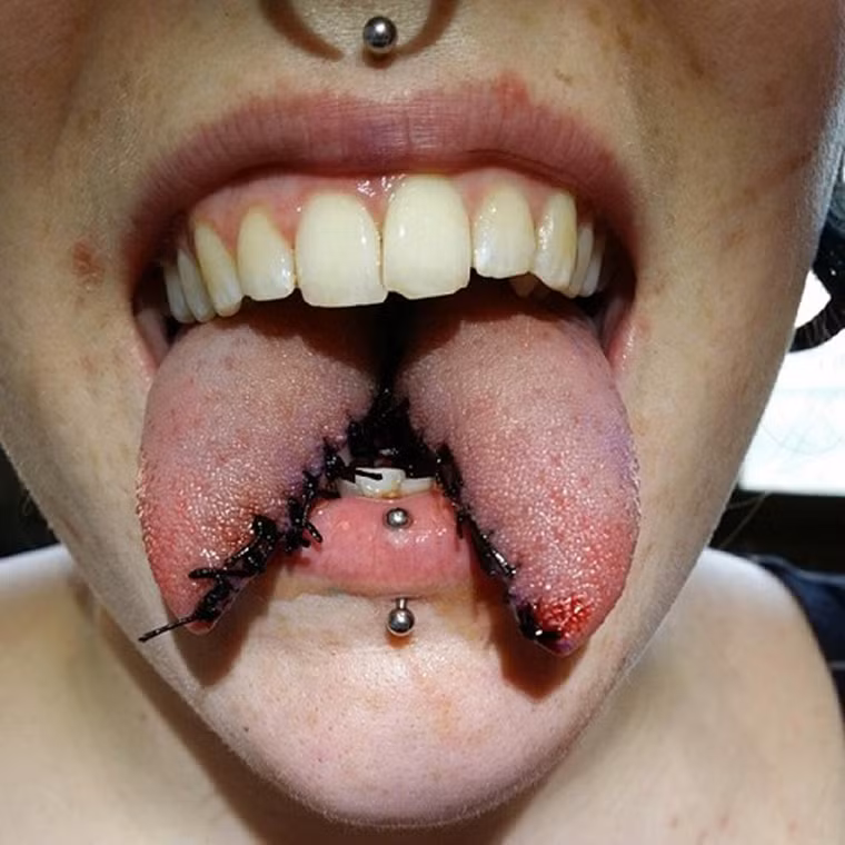 Xẻ lưỡi. Đây là một phương pháp thẩm mỹ mới rộ lên những năm gần đây. Chiếc lưỡi sẽ được thực hiện thủ thuật để tách làm đôi. Sau thời gian kiêng khem, lưỡi họ bình phục và chia làm hai phần riêng biệt giống quỷ sa tăng.