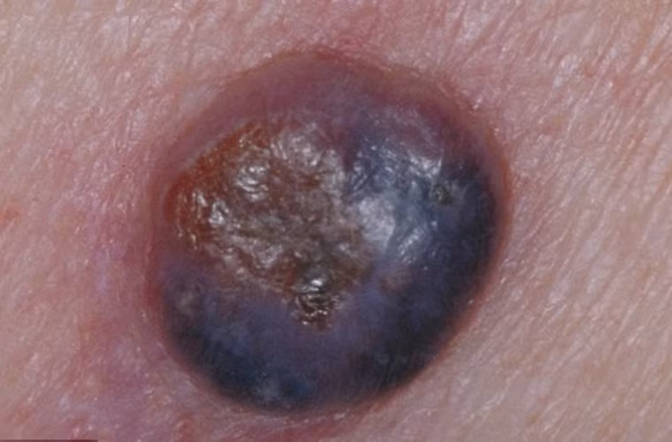 Trong khi mọi người thường cảnh giác với các nốt ruồi xấu xí, bất thường thì khối u nguy hiểm này lại xuất hiện trên da với màu đỏ nhạt. Nó giống một nốt mụn đến mức ngay cả bác sĩ chuyên khoa sau khi quan sát kỹ vẫn có sự nhầm lẫn.