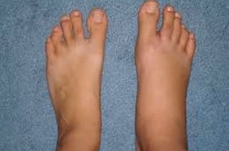 Sưng chân nhưng không rõ lý do.