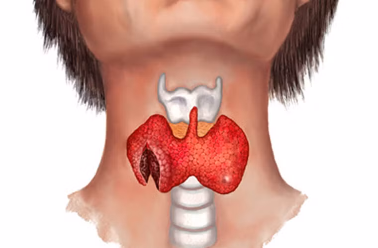 Nhận định trên được đưa ra bởi các nhà khoa học Mỹ. Quá trình nghiên cứu họ nhận thấy những người có tiềm lực kinh tế thường mắc các dạng ung thư ác tính như ung tuyến giáp và ung thư tinh hoàn.