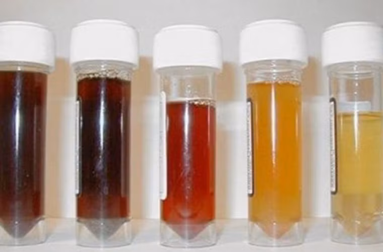 Đi tiểu ra máu trong ung thư bàng quang có hai đặc điểm. Một là người bệnh không hề cảm thấy đau đớn. Y học gọi đó là đi tiểu ra máu không đau. Đặc điểm thứ hai là tính đứt quãng, tức là đi tiểu ra máu theo từng đợt, có thể tự ngưng hoặc giảm bớt, hai lần đi tiểu ra máu có thể cách nhau vài ngày cũng có thể cách vài tháng, thậm chí là nửa năm.