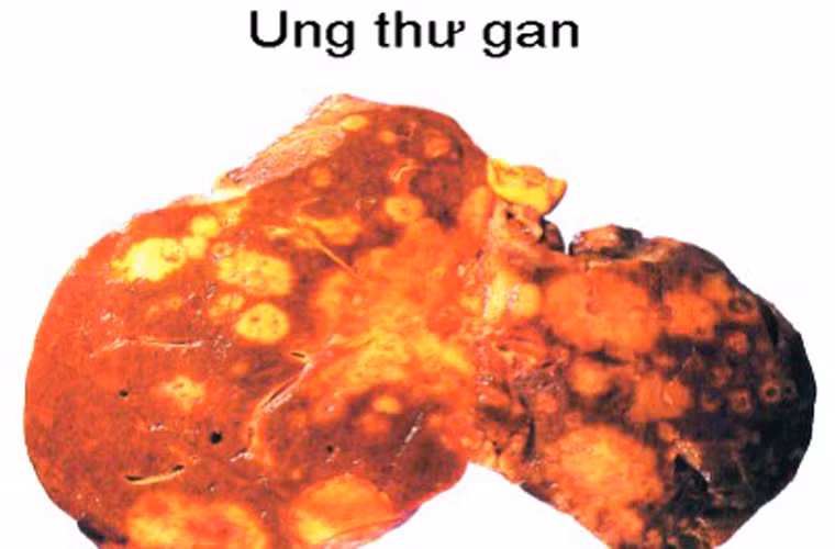 Trong khi đó, ung thư thanh quản, cổ tử cung, dương vật và gan lại thích “hỏi thăm” những người nghèo khó.