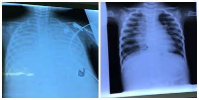 Phim chụp phổi cháu bé trước (hình trái) và sau khi điều trị bằng kỹ thuật ECMO (hình phải).