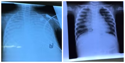 Phim chụp phổi cháu bé trước (hình trái) và sau khi điều trị bằng kỹ thuật ECMO (hình phải).