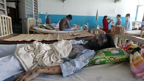  Thủy đậu: Trung bình hàng năm số mắc thủy đậu khoảng 30-40 nghìn trường hợp, bệnh thường nhẹ và hầu như không có tử vong. Tích lũy từ đầu năm 2014 đến nay cả nước ghi nhận 16.380 trường hợp mắc tại hầu hết các tỉnh, thành phố trên cả nước, tính đến thời điểm hiện tại vẫn chưa ghi nhận ca tử tử vong.