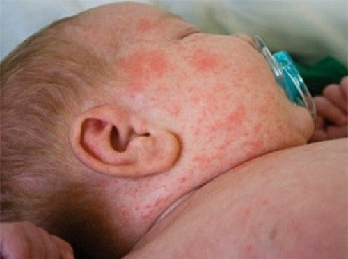  Sởi: Từ đầu năm 2014 đến nay cả nước ghi nhận 4.180 trường hợp mắc sởi xác định trong số 16.168 trường hợp sốt phát ban nghi sởi tại 62/63 tỉnh, thành phố; ghi nhận 136 trường hợp nặng xin về và tử vong liên quan đến sởi tại khu vực miền Bắc.