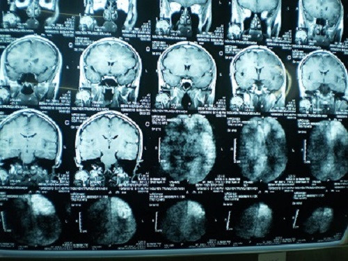  Viêm não vi rút: Đến nay cả nước ghi nhận 191 trường hợp mắc, 03 trường hợp tử vong. So với cùng kỳ 2013 (175/5) số mắc cả nước tăng 9,0%, tử vong giảm 02 trường hợp.