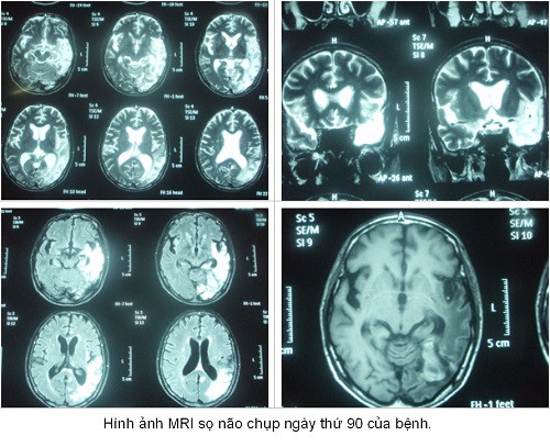Năm 2013 đã có 3.854.311 lượt trẻ chiếm 92,9% đối tượng từ 1-5 tuổi được tiêm mũi 3 vắc xin viêm não Nhật Bản. Bệnh viêm não vi rút thường gia tăng vào mùa hè, do đó trong thời gian tới có thể số mắc tiếp tục gia tăng.