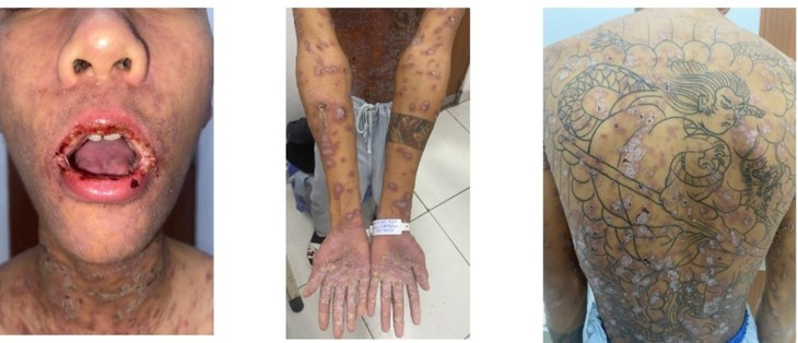 Dieu tri thanh cong ca benh da hiem gap thu 10 tren the gioi