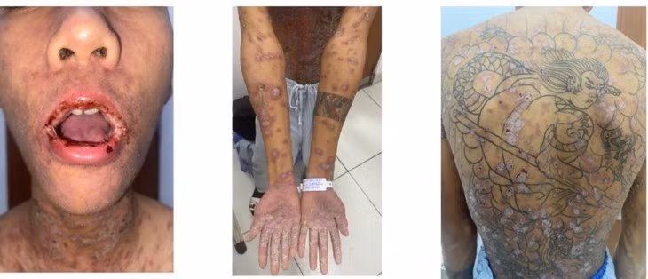 Dieu tri thanh cong ca benh da hiem gap thu 10 tren the gioi