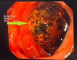 Cu ong bi tac ruot do chu quan soi tui mat nhieu nam-Hinh-3
