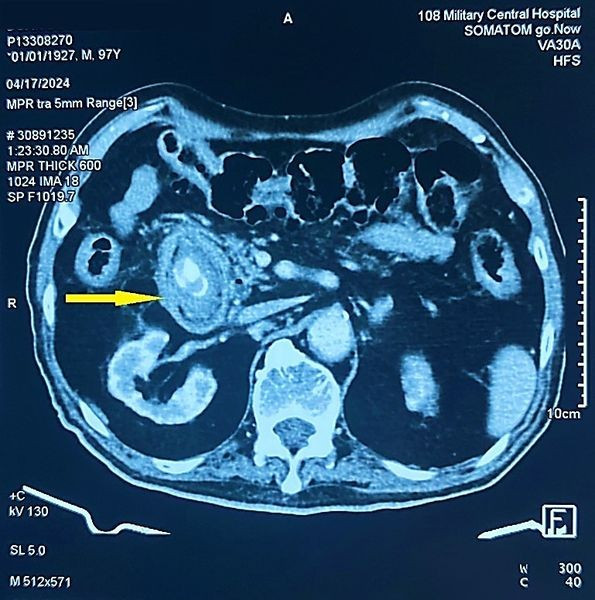 Cu ong bi tac ruot do chu quan soi tui mat nhieu nam-Hinh-2