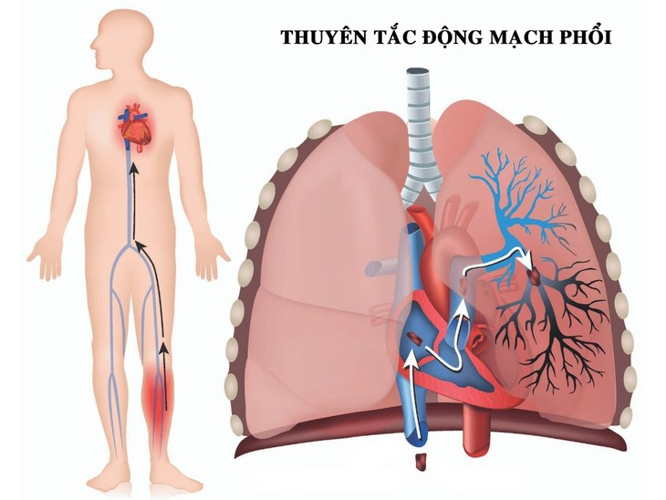 Thuyen tac dong mach phoi, “sat thu” an minh nen can trong-Hinh-2