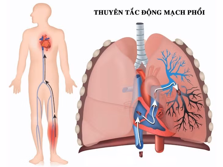 Thuyen tac dong mach phoi, “sat thu” an minh nen can trong-Hinh-2