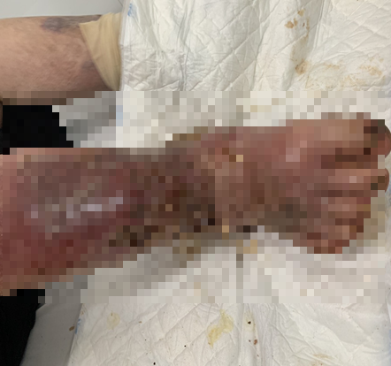 Lam dung thuoc giam dau, benh nhan suy tuyen thuong than