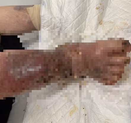 Lam dung thuoc giam dau, benh nhan suy tuyen thuong than