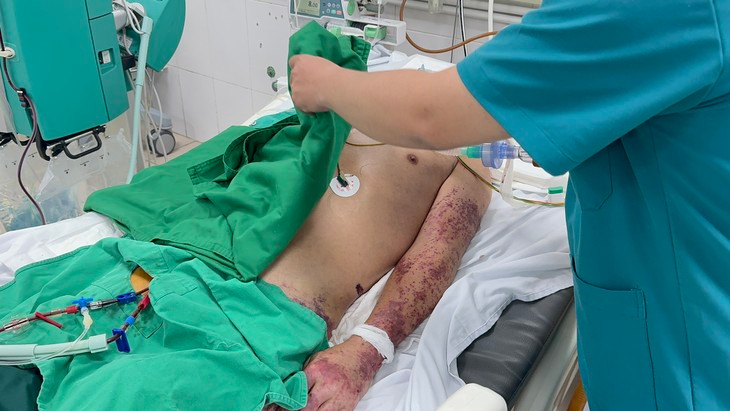 Nguoi dan ong nhiem khuan huyet nguy kich vi mac lien cau lon