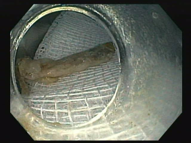 Gắp xương gà 2,5 cm cắm sâu vào thực quản nam bệnh nhân - Hình 2 Gap xuong ga 2,5 cm cam sau vao thuc quan nam benh nhan-Hinh-2