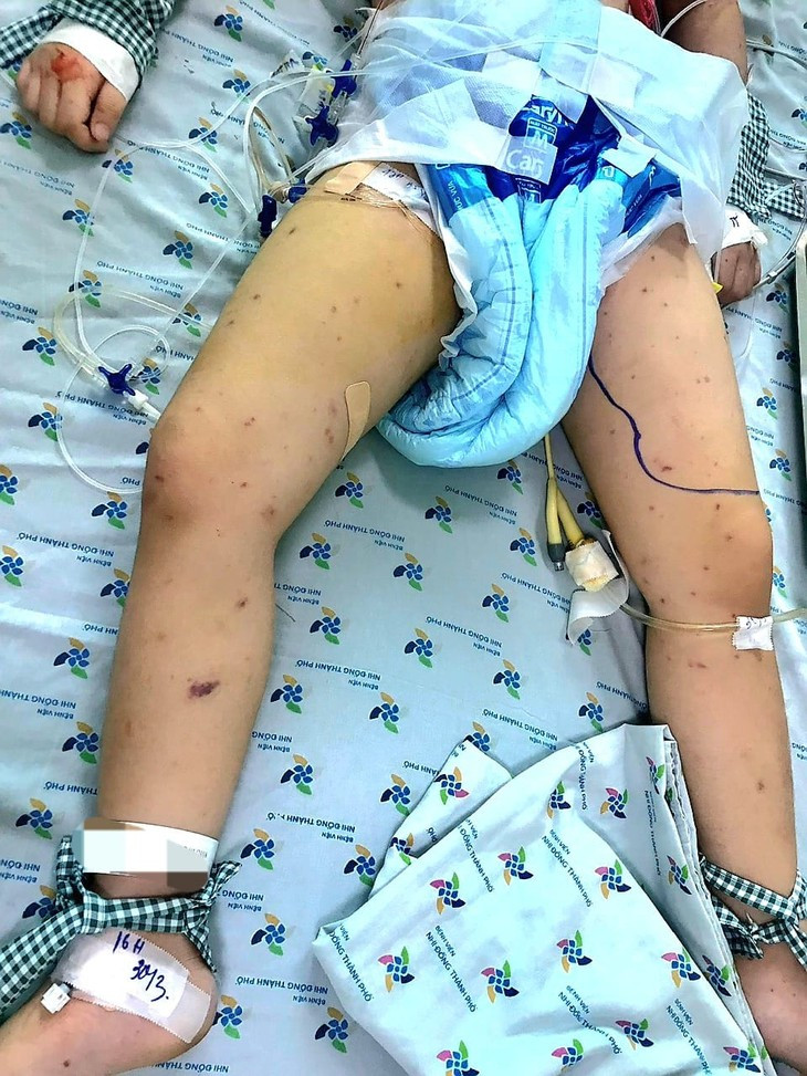 Be gai 5 tuoi nguy kich do nhiem vi khuan nao mo cau