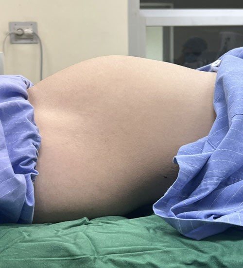 Thieu nu 17 tuoi mang u buong trung nhu co thai 7 thang