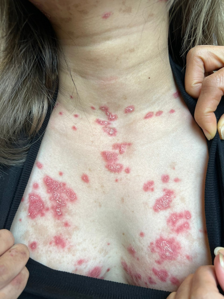 Nu benh nhan ton thuong da co quan vi Lupus ban do-Hinh-2