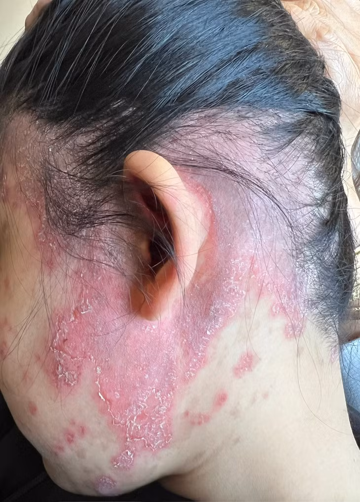 Nu benh nhan ton thuong da co quan vi Lupus ban do