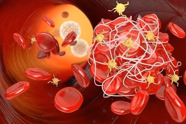 6 thoi quen xau lam tang nguy co hinh thanh cuc mau dong